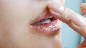 aşırı kuru dudaklara nasıl maske yapılır? kuru dudaklar için öneriler
