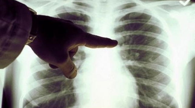 Akciğer kanseri ameliyatı sonrası dikkat edilmesi gerekenler neler?