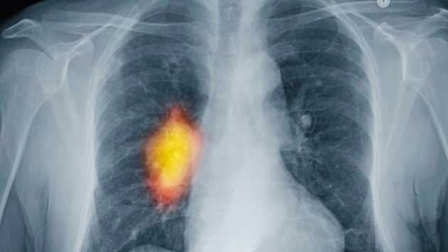 Akciğer kanseri ameliyatı sonrası nelere dikkat edilmeli?