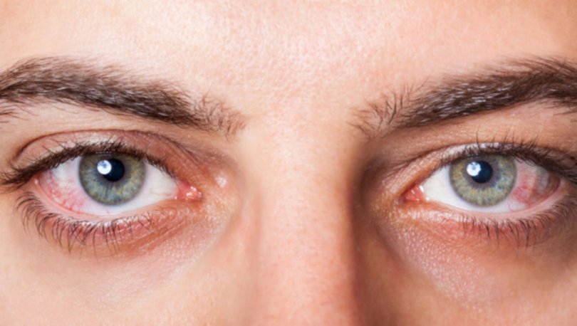 Göz Kuruluğu Nedir Göz Kuruluğu Neden Olur Göz Kuruluğu Tedavisi