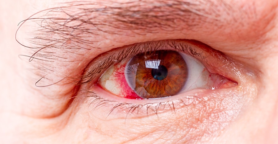 Bilinmeyen Göz Hastalıkları Neler En Tehlikeli Göz Hastalıkları
