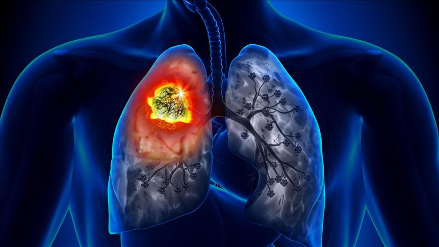 Akciğer Kanseri Kurtulma Şansı